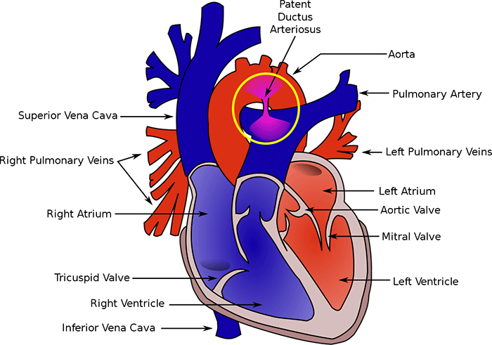 Patent Ductus Arteriosus (PDA)