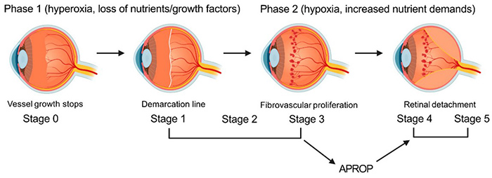 Retinopathy of Prematurity (ROP)