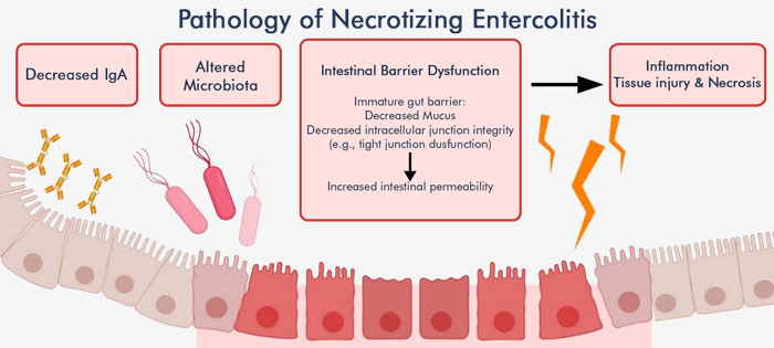 Necrotizing Enterocolitis (NEC)