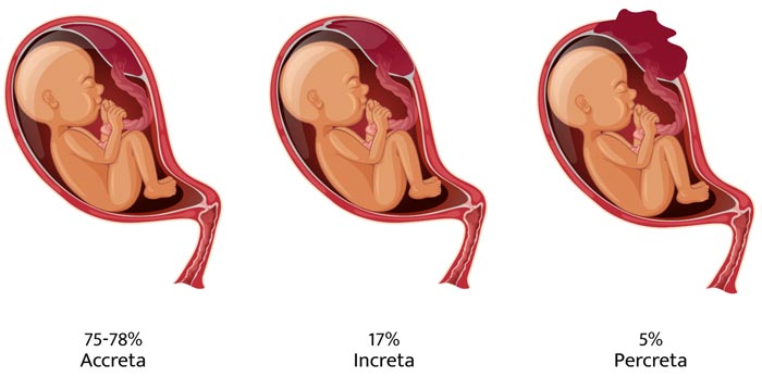 Placenta accreta spectrum (PAS)