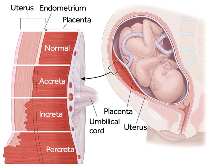 Diagnosing Placenta Previa