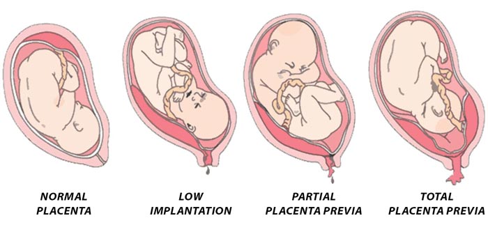 Birth Complications