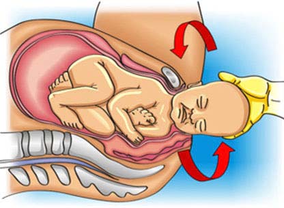 Shoulder Dystocia Injury