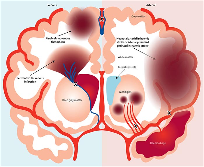 perinatal stroke