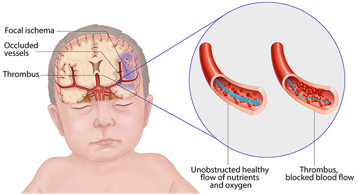 neonatal stroke