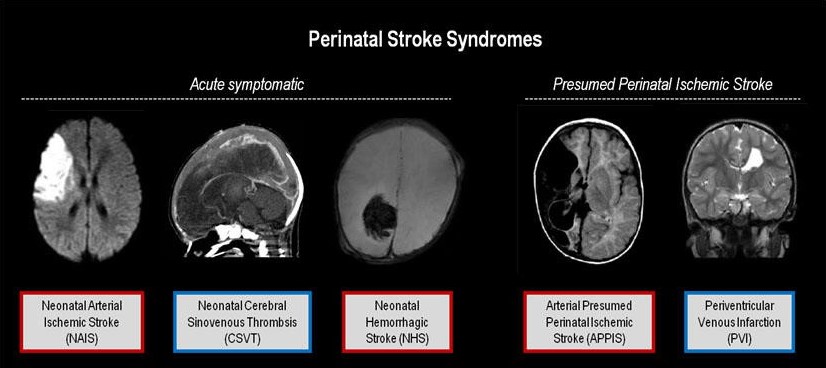 neuroimaging for neonatal stroke