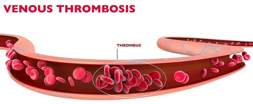 thrombosis