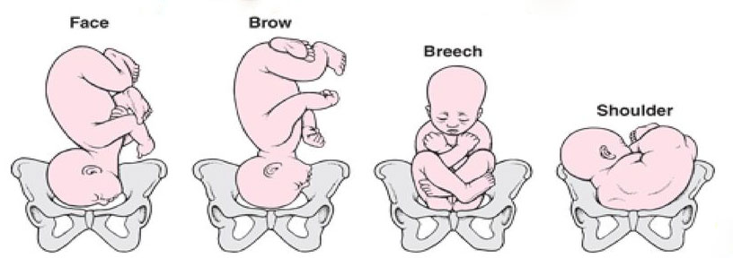 abnormal fetal presentation meaning