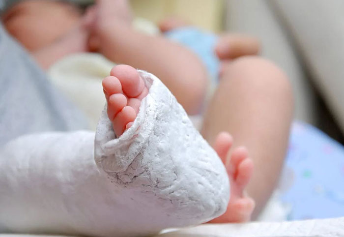 Newborn with Broken Leg