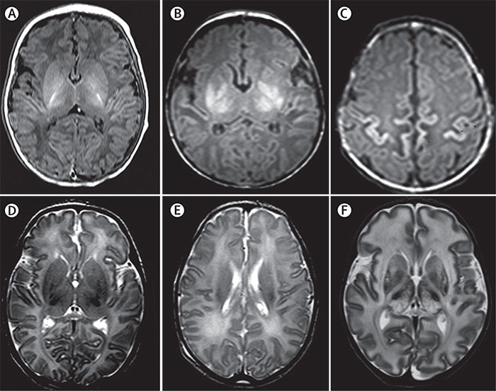 Newborn Brain Scan