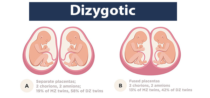 Dichorionic Diamniotic