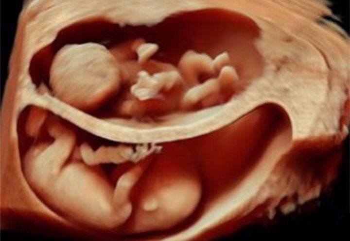 3D-Ultrasound of Twins