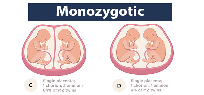 Monochorionic Twins