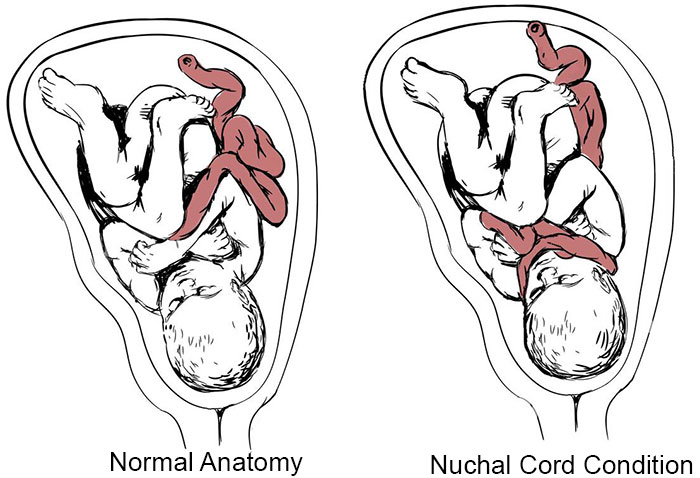 Nuchal Cord