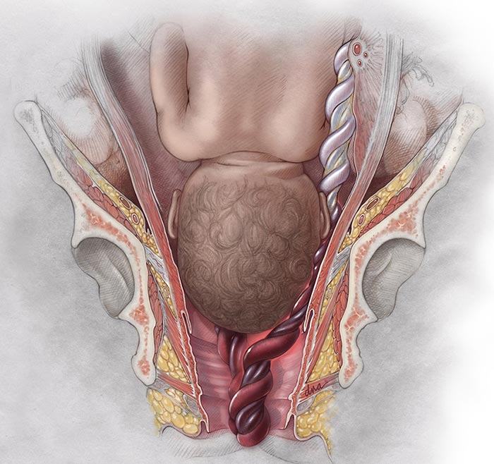 umbilical cord prolapse