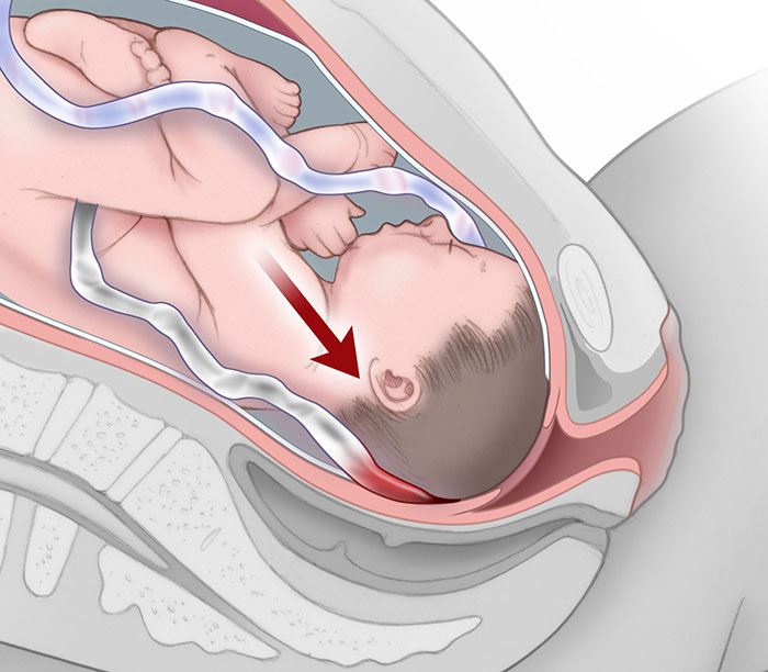 umbilical cord compression