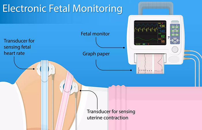 fetal monitoring system