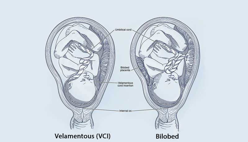 Velamentous Cord Insertion (VCI)