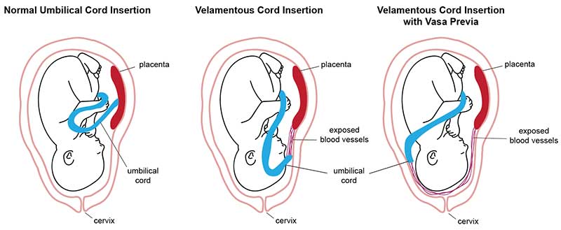 Vasa Previa in Pregnancy