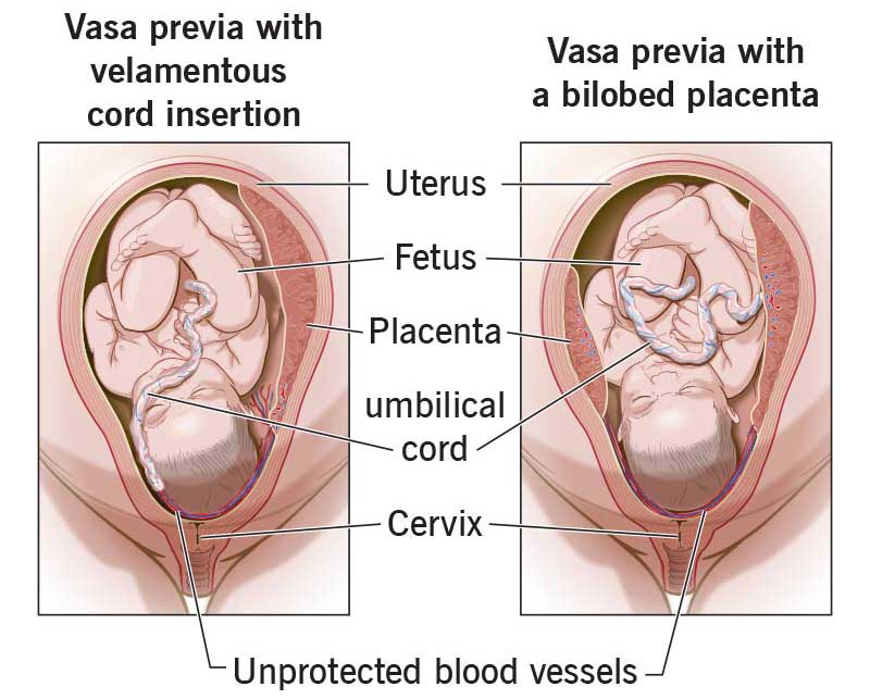 Succenturiate Placenta